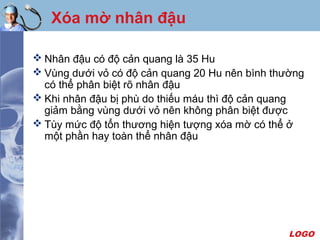 LOGO
Xóa mờ nhân đậu
 Nhân đậu có độ cản quang là 35 Hu
 Vùng dưới vỏ có độ cản quang 20 Hu nên bình thường
có thể phân biệt rõ nhân đậu
 Khi nhân đậu bị phù do thiếu máu thì độ cản quang
giảm bằng vùng dưới vỏ nên không phân biệt được
 Tùy mức độ tổn thương hiện tượng xóa mờ có thể ở
một phần hay toàn thể nhân đậu
 