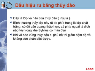 LOGO
Dấu hiệu ru băng thùy đảo
 Ðây là lớp vỏ não cũa thùy đảo ( insula )
 Bình thường thấy lớp này rõ do phía trong là lớp chất
trắng, có độ cản quang thấp hơn, và phía ngoài là dịch
não tủy trong khe Sylvius có màu đen
 Khi vỏ não vùng thùy đảo bị phù nề thì giảm đậm độ và
không còn phân biệt được.
 