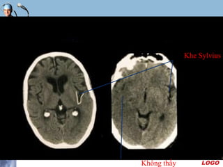 LOGO
Mờ Khe Sylvius
Khe Sylvius
Không thấy
 