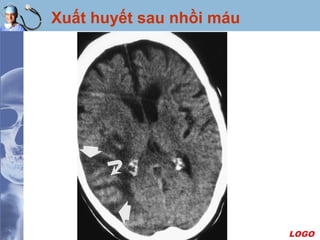 LOGO
Xuất huyết sau nhồi máu
 