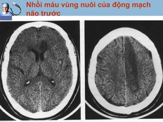 LOGO
Nhồi máu vùng nuôi của động mạch
não trước
www.themegallery.com
 