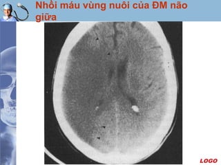 LOGO
Nhồi máu vùng nuôi của ĐM não
giữa
 