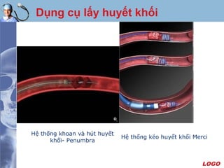 LOGO
Dụng cụ lấy huyết khối
Hệ thống khoan và hút huyết
khối- Penumbra
Hệ thống kéo huyết khối Merci
 