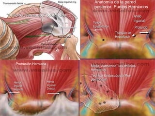 Malla “cubriendo” los orificios herniarios Técnica Endoscópica“Pre-peritoneal” Hernia Inguinal Directa Hernia Inguinal  Indirecta Protrusión Herniaria Triángulo de Hesselbach Vasos Epigástricos Anillo Inguinal Profundo Anatomía de la pared posterior .Puntos Herniarios T. De Hesselbach “ Orificios Herniarios” profundos 
