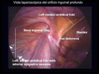 Vista laparoscópica del orificio inguinal profundo 