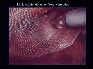 Malla cubriendo los orificios   Herniarios 