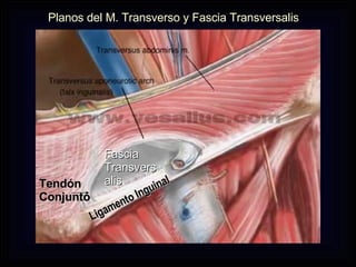 Fascia Transversalis Ligamento Inguinal Planos del M. Transverso y Fascia Transversalis Tendón Conjunto 