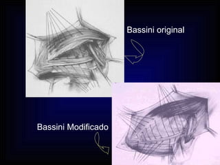 Bassini original Bassini Modificado 