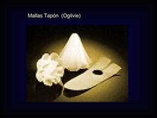 Mallas Tapón  (Ogilvie) 