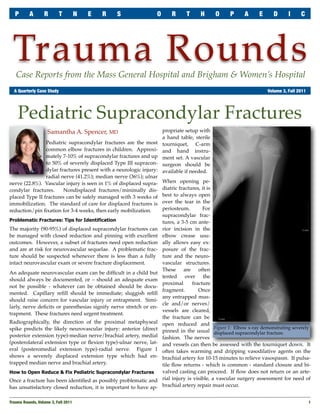 P      A        R       T      N   E   R      S              O       R      T     H      O      P      A      E      D      I     C




 Trauma Rounds
   Case Reports from the Mass General Hospital and Brigham & Women’s Hospital
	 A Quarterly Case Study	                                                                                            Volume 3, Fall 2011




    Pediatric Supracondylar Fractures
                    Samantha A. Spencer, MD                         propriate setup with
                                                                    a hand table, sterile
                Pediatric supracondylar fractures are the most      tourniquet, C-arm
                common elbow fractures in children. Approxi-        and hand instru-
                mately 7-10% of supracondylar fractures and up      ment set. A vascular
                to 50% of severely displaced Type III supracon-     surgeon should be
                dylar fractures present with a neurologic injury:   available if needed.
                radial nerve (41.2%); median nerve (36%); ulnar
nerve (22.8%). Vascular injury is seen in 1% of displaced supra-    When opening pe-
condylar fractures.     Nondisplaced fractures/minimally dis-       diatric fractures, it is
placed Type II fractures can be safely managed with 3 weeks of      best to always open
immobilization. The standard of care for displaced fractures is     over the tear in the
reduction/pin ﬁxation for 3-4 weeks, then early mobilization.       periosteum.        For
                                                                    supracondylar frac-
Problematic Fractures: Tips for Identification                      tures, a 3-5 cm ante-
The majority (90-95%) of displaced supracondylar fractures can      rior incision in the
be managed with closed reduction and pinning with excellent         elbow crease usu-
outcomes. However, a subset of fractures need open reduction        ally allows easy ex-
and are at risk for neurovascular sequelae. A problematic frac-     posure of the frac-
ture should be suspected whenever there is less than a fully        ture and the neuro-
intact neurovascular exam or severe fracture displacement.          vascular structures.
                                                                    These are often
An adequate neurovascular exam can be difﬁcult in a child but
                                                                    tented over the
should always be documented, or – should an adequate exam
                                                                    proximal      fracture
not be possible - whatever can be obtained should be docu-
                                                                    fragment.        Once
mented. Capillary reﬁll should be immediate; sluggish reﬁll
                                                                    any entrapped mus-
should raise concern for vascular injury or entrapment. Simi-
                                                                    cle and/or nerves/
larly, nerve deﬁcits or paresthesias signify nerve stretch or en-
                                                                    vessels are cleared,
trapment. These fractures need urgent treatment.
                                                                    the fracture can be
Radiographically, the direction of the proximal metaphyseal         open reduced and
spike predicts the likely neurovascular injury: anterior (direct                             Figure 1: Elbow x-ray demonstrating severely
                                                                    pinned in the usual displaced supracondylar fracture.
posterior extension type)-median nerve/brachial artery, medial      fashion. The nerves
(posterolateral extension type or ﬂexion type)-ulnar nerve, lat-    and vessels can then be assessed with the tourniquet down. It
eral (posteromedial extension type)-radial nerve. Figure 1          often takes warming and dripping vasodilative agents on the
shows a severely displaced extension type which had en-             brachial artery for 10-15 minutes to relieve vasospasm. If pulsa-
trapped median nerve and brachial artery.                           tile ﬂow returns - which is common - standard closure and bi-
How to Open Reduce & Fix Pediatric Supracondylar Fractures          valved casting can proceed. If ﬂow does not return or an arte-
Once a fracture has been identiﬁed as possibly problematic and      rial injury is visible, a vascular surgery assessment for need of
has unsatisfactory closed reduction, it is important to have ap-    brachial artery repair must occur.


Trauma Rounds, Volume 3, Fall 2011
                                                                                                        1
 