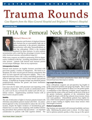 P        A     R       T       N     E   R   S                 O       R      T      H      O      P      A      E      D       I     C




 Trauma Rounds
   Case Reports from the Mass General Hospital and Brigham & Women’s Hospital
	 A Quarterly Case Study	                                                                                             Volume 2, Spring 2011




       THA for Femoral Neck Fractures
                    Michael J Weaver, MD
                 The reduction and ﬁxation of displaced femoral
                 neck fractures has an unacceptably high rate of
                 failure, particularly in the geriatric population.
                 Reconstruction with either hemiarthroplasty or
                 total hip arthroplasty (THA) is the accepted
                 treatment for these fractures. In active patients
reconstruction with a total hip has advantages in terms of pain
relief, functional outcome, and prosthesis longevity1.
While many surgeons are skilled in performing THA for degen-
erative conditions of the hip - including osteoarthritis and avas-
cular necrosis - patients with femoral neck fractures present
several unique challenges. Here are my experiences:
Intraoperative Fracture
Femoral neck fractures are fragility fractures associated with
poor bone quality, a marker of osteoporosis. The trend in ar-         Figure 1: Pre-operative pelvic AP is the template to guide radiographic
throplasty has been toward press-ﬁt femoral components that           placement of the cup. Adjust the C-arm orientation to recreate this
allow for bone ingrowth and long-term stability. Thus, I use          image.
ingrowth femoral stems with a more canal-ﬁlling geometry in-
stead of taper-type stems to reduce hoop stresses and prevent         newer highly cross-linked polyethylene liners allow for larger
fracture. A doubled up 16-gauge circlage wire should be placed        femoral head sizes that improve stability.
prophylactically between the greater and lesser trochanters           Leg Length Discrepancy
prior to broaching.                                                   Many arthroplasty surgeons use pre-operative leg lengths to
Care must also be taken with placement and impacting of the           guide component position and gauge leg lengths. This is more
acetabular component. There is usually no subchondral sclero-         challenging in fracture patients as there is no one perfect guide.
sis, and it can be easy to breach the medial wall with the ace-       A combination of the following is helpful: visual inspection to
tabular reamers. Supplementing acetabular ﬁxation with at             ensure that the center of the new head is at the level of the tip of
least 2 screws can prove useful.                                      the greater trochanter; palpation of the contralateral knee
                                                                      through the drapes with the hip reduced; tissue tension; shuck;
Stability                                                             and c-arm guidance. Osteoarthritic patients have tighter tis-
The rate of dislocation is higher in fracture patients treated with   sues, while fracture patients typically have normal hip anatomy
THA than osteoarthritis patients treated with THA2. An antero-        prior to injury leading to slightly looser tissue tension when
lateral approach is thus recommended to reduce the risk of dis-       limb length is restored.
location, despite the higher incidence of Trendelenburg gait3.        Medical Complications
Patients have an easier time complying with modiﬁed anterior          Hip fractures are associated with increased morbidity and mor-
hip precautions than posterior hip precautions – an important         tality. Mobilizing the patient early is critical. It is thus impor-
consideration for patients with mild cognitive deﬁcits. The           tant to optimize patients quickly, so they may go to the operat-


Trauma Rounds, Volume 2, Spring 2011
                                                                                                         1
 