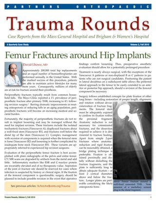P      A        R       T      N   E   R     S                 O       R     T     H     O      P     A       E      D      I     C




 Trauma Rounds
   Case Reports from the Mass General Hospital and Brigham & Women’s Hospital
	 A Quarterly Case Study	                                                                                            Volume 2, Fall 2010




Femur Fractures around Hip Implants
                    David Lhowe, MD                                   ﬁndings conﬁrm loosening. Thus, preoperative anesthetic
                                                                      evaluation should allow for a potentially prolonged procedure.
                  Approximately 200,000 total hip replacements
                                                                      Treatment is nearly always surgical, with the exceptions of the
                  and an equal number of hemiarthroplasties are
                                                                      Vancouver A patterns or non-displaced B or C patterns in pa-
                  performed annually in the United States. With
                                                                      tients who are not surgical candidates. Positioning the patient
                  the marked success of this procedure, patients
                                                                      in lateral decubitus on a radiolucent table allows the preferred
                  are able to maintain active lifestyles for many
                                                                      lateral approach to the femur to be easily extended to an ante-
                  more years. Consequently, millions of elderly
                                                                      rior or posterior hip approach, should a revision of the femoral
are at risk for fracture around their prosthesis.
                                                                      component be necessary.
Periprosthetic fractures typically result from common house-
                                                                      Surgery follows established concepts for plate ﬁxation of other
hold falls. The Mayo Clinic reported a 1% prevalence of peri-
                                                                      long bones - including restoration of proper length, alignment,
prosthetic fracture after primary THR, increasing to 4% follow-
                                                                      and rotation without devas-
ing revision surgery.1 Barring dramatic improvements in treat-
                                                                      cularization of fracture frag-
ing osteoporosis or reducing falls in an aging population, peri-
                                                                      ments. The femoral stem
prosthetic fractures will become an increasing medical and so-
                                                                      must be adequately exposed
cietal burden.
                                                                      to conﬁrm its ﬁxation within
Fortunately, the majority of periprosthetic fractures do not re-      the    proximal     fragment.
sult in implant loosening and may be managed without the              Anatomic reduction is not
need for implant revision. These fractures include the isolated       necessary for comminuted
trochanteric fractures (Vancouver A), diaphyseal fractures about      fractures, and the dissection
a well-ﬁxed stem (Vancouver B1), and fractures well below the         required to achieve it is det-
distal tip of the stem (Vancouver C). Complex management              rimental to fracture healing.
with revision of components is required when the femoral stem         Apart from simple 2-part
is loose (Vancouver B2) and loosening is further complicated by       fractures where anatomic
inadequate bone stock (Vancouver B3). These variants are ap-          reduction and rigid ﬁxation
propriately referred to experienced hip revision surgeons.            can be reasonably obtained, a
                                                                      bridge plating technique is
Evaluation of the periprosthetic femur fracture is best accom-
                                                                      preferable. Fixation is ob-
plished with plain radiographs of the pelvis and entire femur.
                                                                      tained proximally and dis-
CT/MR scans are degraded by artifacts from the metal and add
                                                                      tally without disturbing the
little. Inﬂammatory markers like ESR and C-reactive protein
                                                                      fracture fragments, and the
are invariably elevated and of no therapeutic value. Aspiration
                                                                      plate is sufﬁciently long to
of the joint or fracture site should be reserved for cases where
                                                                      obtain adequate ﬁxation – at
infection is suspected by history or clinical signs. If the ﬁxation
                                                                      least 2 cortical diameters
of the femoral component is questionable, surgery should be
                                                                      above and below the frac-
planned to include possible revision in the event that operative
                                                                      ture. Longer plates are pref- Above: Femur fracture around a
                                                                      erable considering the likely well-ﬁxed cemented THR.   Note
       See previous articles: AchesAndJoints.org/Trauma               osteoporotic bone.             presence of a medullary cement
                                                                                                    plug in the distal fragment.


Trauma Rounds, Volume 2, Fall 2010
                                                                                                        1
 