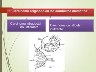 1. Carcinoma originado en los conductos mamarios:
Carcinoma intraductal
no infiltrante
Carcinoma canalicular
infiltrante:
 