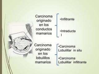 Carcinoma
originado
en los
conductos
mamarios
•Infiltrante
•Intraducta
l
Carcinoma
originado
en los
lobulillos
mamarios
•Carcinoma
Lobulillar in situ
•Carcinoma
Lobulillar infiltrante
 