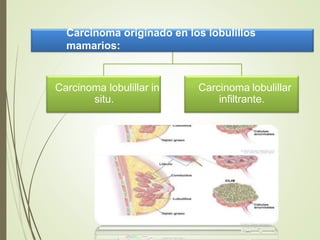 Carcinoma originado en los lobulillos
mamarios:
Carcinoma lobulillar in
situ.
Carcinoma lobulillar
infiltrante.
 