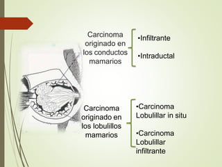 Carcinoma
originado en
los conductos
mamarios
•Infiltrante
•Intraductal
Carcinoma
originado en
los lobulillos
mamarios
•Carcinoma
Lobulillar in situ
•Carcinoma
Lobulillar
infiltrante
 