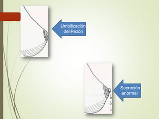 Umbilicación
del Pezón
Secreción
anormal
 