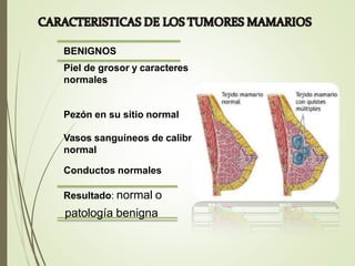 BENIGNOS
Piel de grosor y caracteres
normales
Pezón en su sitio normal
Vasos sanguíneos de calibre
normal
Conductos normales
Resultado: normal o
patología benigna
 