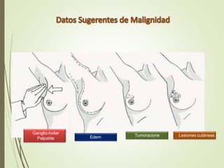 Ganglio Axilar
Palpable Edem
a
Tumoracione
s
Lesiones cutáneas
 