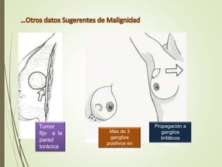 Propagación a
ganglios
linfáticos
internos
Tumor
fijo a la
pared
torácica
Más de 3
ganglios
positivos en
pieza quirúrgica
 