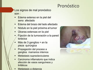 Pronóstico
Los signos de mal pronóstico
son :
 Edema extenso en la piel del
seno afectado
 Edema del brazo del lado afectado
 Nódulo en la piel próxima al tumor
 Úlceras extensas en la piel
 Fijación de la tumoración a la pared
torácica
 Más de 3 ganglios + en la
pieza quirúrgica
 Propagación del proceso a
ganglios mamarios internos
 Metástasis supraclaviculares
 Carcinoma inflamatorio que indica
afección de vasos sanguíneos y
linfáticos
 Metástasis a distancia
 