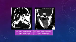 FIG. 6 T. C. corte axial (CT
Sytec 2000, GE)R
FIG. 7 T. C. corte coronal (CT
Sytec 2000, GE)R
 