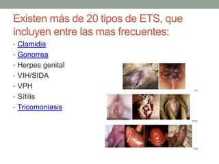 Existen más de 20 tipos de ETS, que
incluyen entre las mas frecuentes:
• Clamidia
• Gonorrea
• Herpes genital
• VIH/SIDA
• VPH
• Sífilis
• Tricomoniasis
 