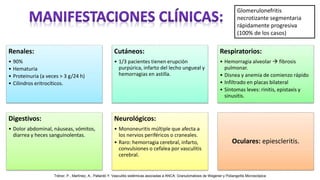 Glomerulonefritis
necrotizante segmentaria
rápidamente progresiva
(100% de los casos)
Renales:
• 90%
• Hematuria
• Proteinuria (a veces > 3 g/24 h)
• Cilindros eritrocíticos.
Cutáneos:
• 1/3 pacientes tienen erupción
purpúrica, infarto del lecho ungueal y
hemorragias en astilla.
Respiratorios:
• Hemorragia alveolar  fibrosis
pulmonar.
• Disnea y anemia de comienzo rápido
• Infiltrado en placas bilateral
• Síntomas leves: rinitis, epistaxis y
sinusitis.
Digestivos:
• Dolor abdominal, náuseas, vómitos,
diarrea y heces sanguinolentas.
Neurológicos:
• Mononeuritis múltiple que afecta a
los nervios periféricos o craneales.
• Raro: hemorragia cerebral, infarto,
convulsiones o cefalea por vasculitis
cerebral.
Oculares: epiescleritis.
Trénor, P., Martínez, A., Pallardó Y. Vasculitis sistémicas asociadas a ANCA: Granulomatosis de Wegener y Poliangeítis Microscópica
 