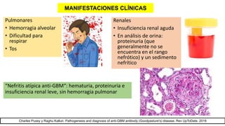 Renales
• Insuficiencia renal aguda
• En análisis de orina:
proteinuria (que
generalmente no se
encuentra en el rango
nefrótico) y un sedimento
nefrítico
Pulmonares
• Hemorragia alveolar
• Dificultad para
respirar
• Tos
Charles Pusey y Raghu Kalluri. Pathogenesis and diagnosis of anti-GBM antibody (Goodpasture's) disease. Rev UpToDate. 2018
“Nefritis atípica anti-GBM“: hematuria, proteinuria e
insuficiencia renal leve, sin hemorragia pulmonar
MANIFESTACIONES CLÍNICAS
 