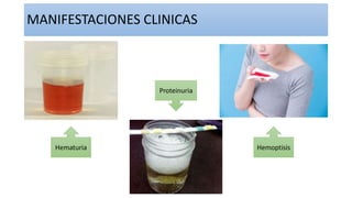 MANIFESTACIONES CLINICAS
PúrpuraHematuria
Proteinuria
Dolor
abdominal
Hemoptisis
 