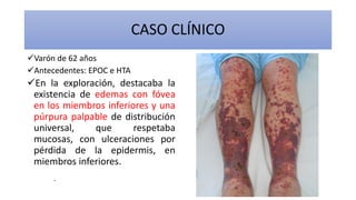 CASO CLÍNICO
Varón de 62 años
Antecedentes: EPOC e HTA
Ingresó por lesiones purpúricas,
confluentes y con tendencia al
desarrollo de flictenas o úlceras, que
comenzaron días previos en los
miembros inferiores; aumentaron en
número y se extendieron a las nalgas,
el tronco, los miembros superiores y la
cara, acompañadas de artralgias en las
manos y los pies. No existieron
trastornos gastrointestinales ni fiebre
ni otra clínica sugestiva de enfermedad
del tejido conectivo.
En la exploración, destacaba la
existencia de edemas con fóvea
en los miembros inferiores y una
púrpura palpable de distribución
universal, que respetaba
mucosas, con ulceraciones por
pérdida de la epidermis, en
miembros inferiores.
 