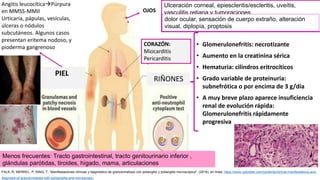 RIÑONES
• Glomerulonefritis: necrotizante
• Aumento en la creatinina sérica
• Hematuria: cilindros eritrocíticos
• Grado variable de proteinuria:
subnefrótica o por encima de 3 g/día
• A muy breve plazo aparece insuficiencia
renal de evolución rápida:
Glomerulonefritis rápidamente
progresiva
OJOS
Ulceración corneal, epiescleritis/escleritis, uveítis,
vasculitis retiana y tumoraciones
retroorbitariasneuropatía óptica /obstrucción del
conducto nasolagrimal
dolor ocular, sensación de cuerpo extraño, alteración
visual, diplopía, proptosis
Angitis leucocíticaPúrpura
en MMSS-MMII
Urticaria, pápulas, vesículas,
úlceras o nódulos
subcutáneos. Algunos casos
presentan eritema nodoso, y
pioderma gangrenoso
PIEL
CORAZÓN:
Miocarditis
Pericarditis
Menos frecuentes: Tracto gastrointestinal, tracto genitourinario inferior ,
glándulas parótidas, tiroides, hígado, mama, articulaciones
FALK, R, MERKEL, P, KING, T: “Manifestaciones clínicas y diagnóstico de granulomatosis con poliangitis y poliangitis microscópica”, (2016), en línea: https://www.uptodate.com/contents/clinical-manifestations-and-
diagnosis-of-granulomatosis-with-polyangiitis-and-microscopic-
 