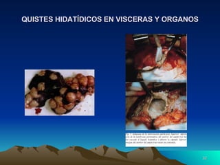 QUISTES HIDATÍDICOS EN VISCERAS Y ORGANOS 