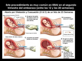 Este procedimiento es muy común en EEUU en el segundo trimestre del embarazo (entre las 12 y las 20 semanas). 