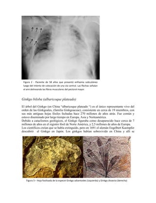 Ginkgo biloba (albaricoque plateado) 
El árbol del Ginkgo (en China “albaricoque plateado “) es el único representante vivo del 
orden de las Ginkgoales, (familia Ginkgoaceae), consistente en cerca de 19 miembros, con 
sus más antiguas hojas fósiles fechadas hace 270 millones de años atrás. Fue común y 
estuvo diseminado por largo tiempo en Europa, Asia y Norteamérica. 
Debido a cataclismos geológicos, el Ginkgo figuraba como desaparecido hace cerca de 7 
millones de años en el registro fósil de Norte América, y 2,5 millones de años de Europa. 
Los científicos creían que se había extinguido, pero en 1691 el alemán Engelbert Kaempfer 
descubrió el Ginkgo en Japón. Los ginkgos habían sobrevivido en China y allí se 
Figura 3 – Hoja fosilisada de la especie Ginkgo adiantoides (izquierda) y Ginkgo dissecta (derecha) 
Figura 2 - Paciente de 58 años que presentó enfisema subcutáneo 
luego del intento de colocación de una vía central. Las flechas señalan 
el aire delineando las fibras musculares del pectoral mayor. 
 