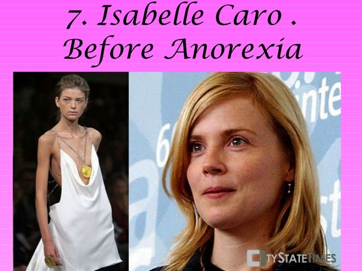 Trabajo Anorexia