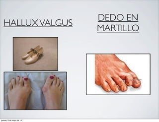 HALLUXVALGUS
DEDO EN
MARTILLO
jueves, 8 de mayo de 14
 