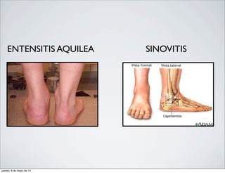 ENTENSITIS AQUILEA SINOVITIS
jueves, 8 de mayo de 14
 