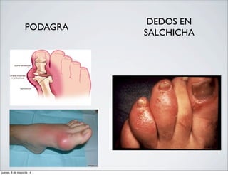 PODAGRA
DEDOS EN
SALCHICHA
jueves, 8 de mayo de 14
 