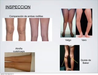 INSPECCION
Comparación de ambas rodillas
Valgo Varo
Atrofia
cuádriceps
Quiste de
Baker
jueves, 8 de mayo de 14
 