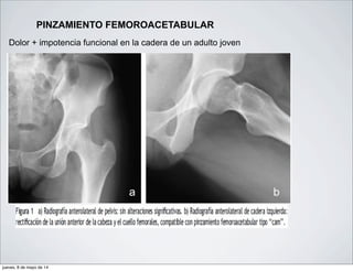 PINZAMIENTO FEMOROACETABULAR
Dolor + impotencia funcional en la cadera de un adulto joven
jueves, 8 de mayo de 14
 