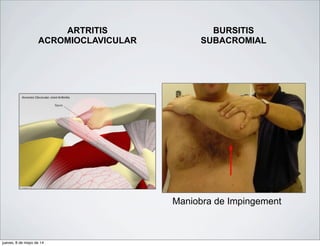 ARTRITIS
ACROMIOCLAVICULAR
BURSITIS
SUBACROMIAL
Maniobra de Impingement
jueves, 8 de mayo de 14
 