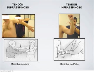 TENDÓN
SUPRAESPINOSO
Maniobra de Jobe
TENDÓN
INFRAESPINOSO
Maniobra de Patte
jueves, 8 de mayo de 14
 