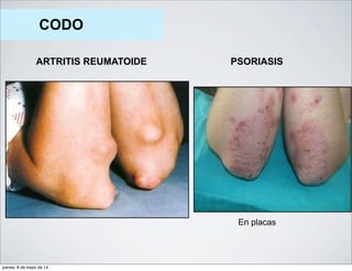 CODO
ARTRITIS REUMATOIDE PSORIASIS
En placas
jueves, 8 de mayo de 14
 