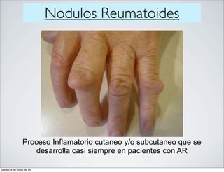 Nodulos Reumatoides
Proceso Inflamatorio cutaneo y/o subcutaneo que se
desarrolla casi siempre en pacientes con AR
jueves, 8 de mayo de 14
 