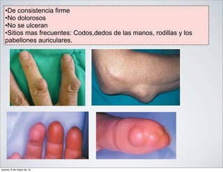 •De consistencia firme
•No dolorosos
•No se ulceran
•Sitios mas frecuentes: Codos,dedos de las manos, rodillas y los
pabellones auriculares.
jueves, 8 de mayo de 14
 