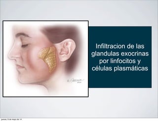 Infiltracion de las
glandulas exocrinas
por linfocitos y
células plasmáticas
jueves, 8 de mayo de 14
 