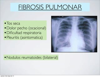 FIBROSIS PULMONAR
•Tos seca
•Dolor pecho (ocacional)
•Diﬁcultad respiratoria
•Pleuritis (asintomatica)
•Nodulos reumatoides (bilateral)
jueves, 8 de mayo de 14
 