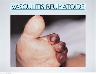 VASCULITIS REUMATOIDE
jueves, 8 de mayo de 14
 