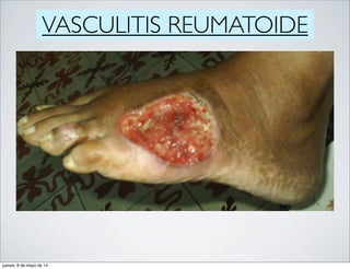 VASCULITIS REUMATOIDE
jueves, 8 de mayo de 14
 